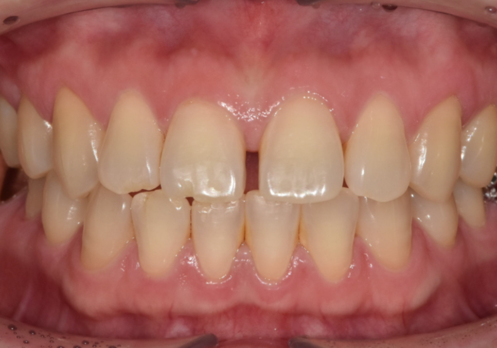 고덕동 치간 이개, 위 앞니 벌어짐, 교정? 라미네이트? 고민이시라면 필독 관련 이미지 1