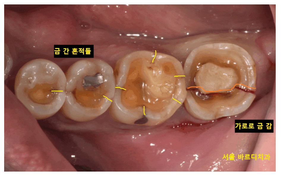어금니 금감 발치 후 임플란트 풍산동 치과에서 진행했습니다. 관련 이미지 1