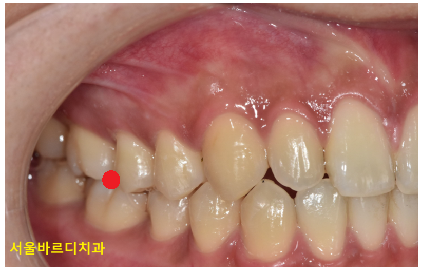 치아 중심선 안맞을 때 걱정스러우신 분들이라면? 관련 이미지 6