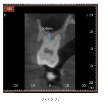 길동 치과 임플란트 뼈이식 흡연 관련 있을까? 관련 이미지 5