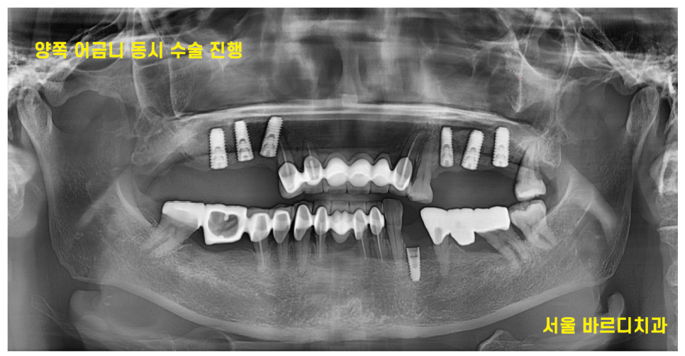 고덕동 치과 뼈이식 동반 양쪽 어금니 임플란트 동시 진행 관련 이미지 7