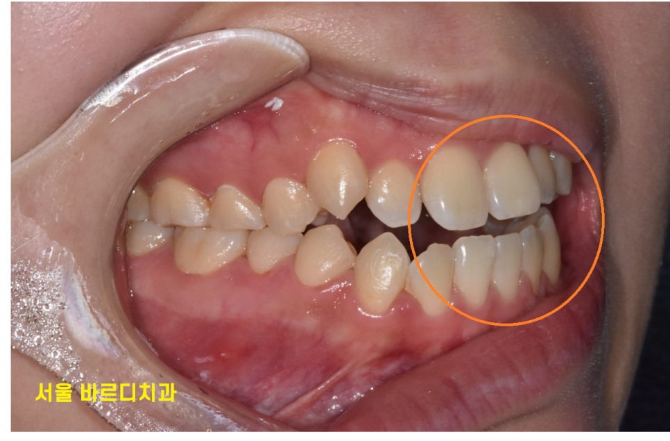 길동 치아교정 통증 겪어보지 않았기에 어느정도일까? 관련 이미지 4