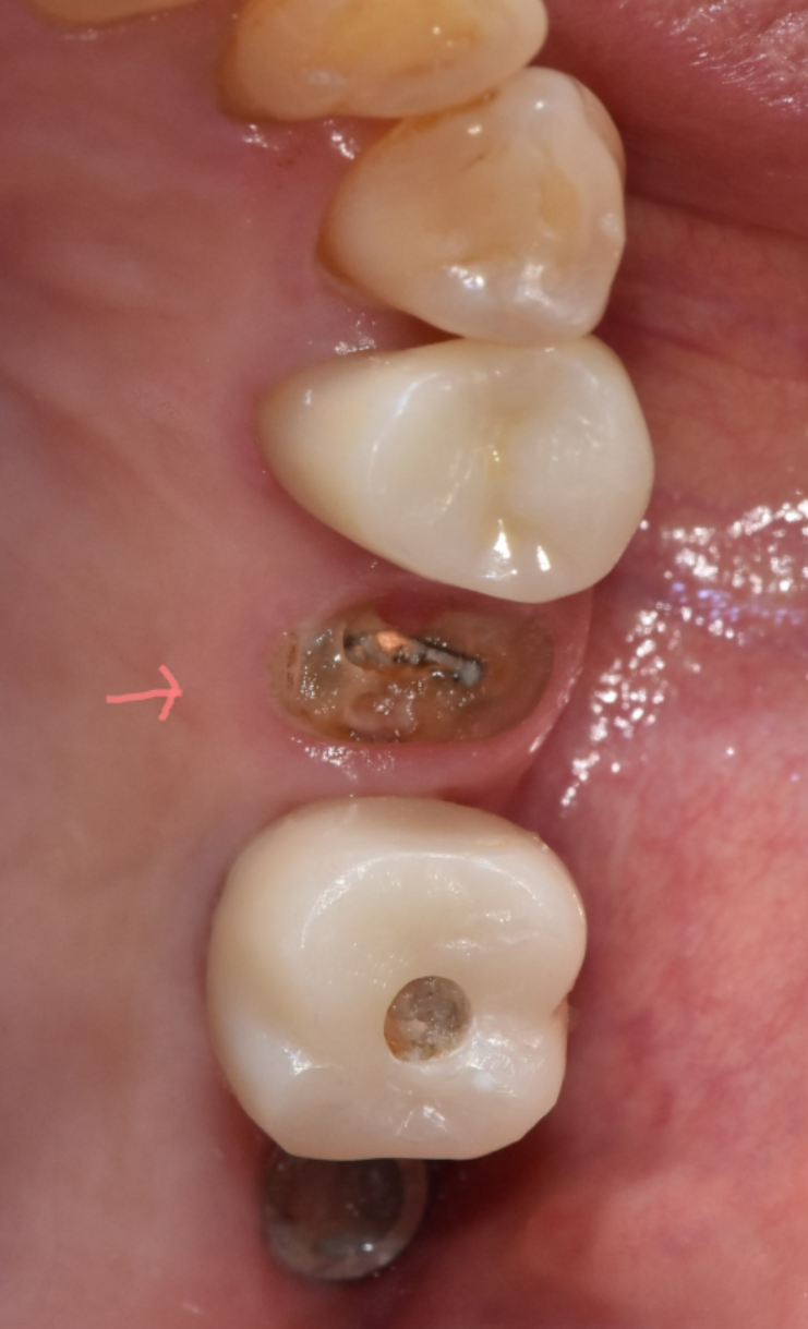 치아 크라운 빠짐 내부 충치가 심할때는 임플란트가 필요합니다. 관련 이미지 6