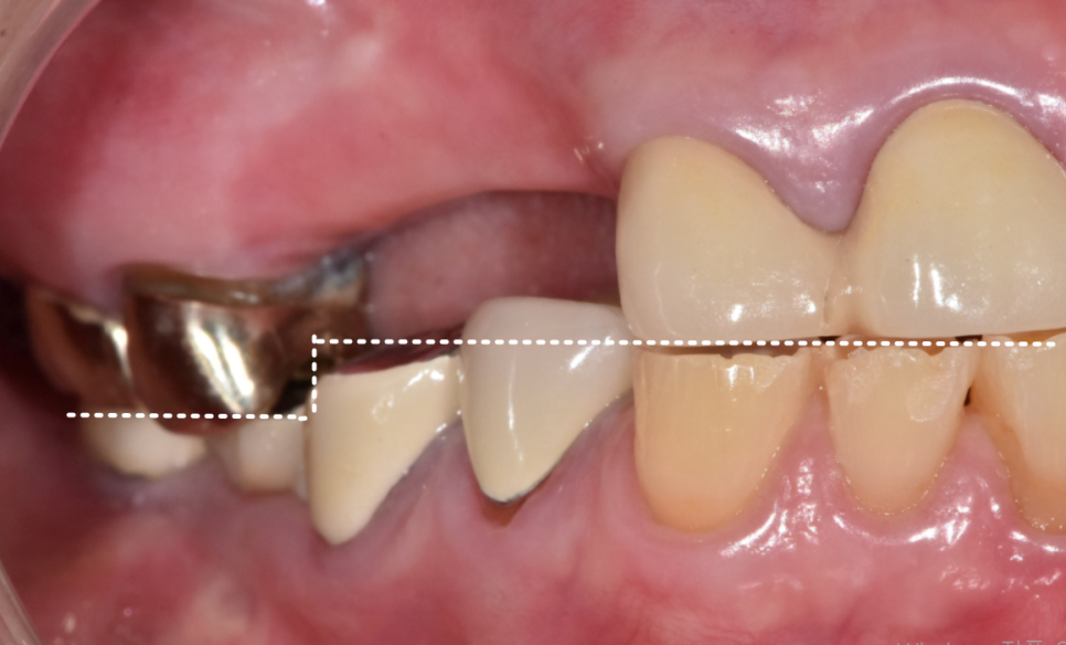 합죽이입 처럼 보이는 이유, 낮아진 관련 이미지 2