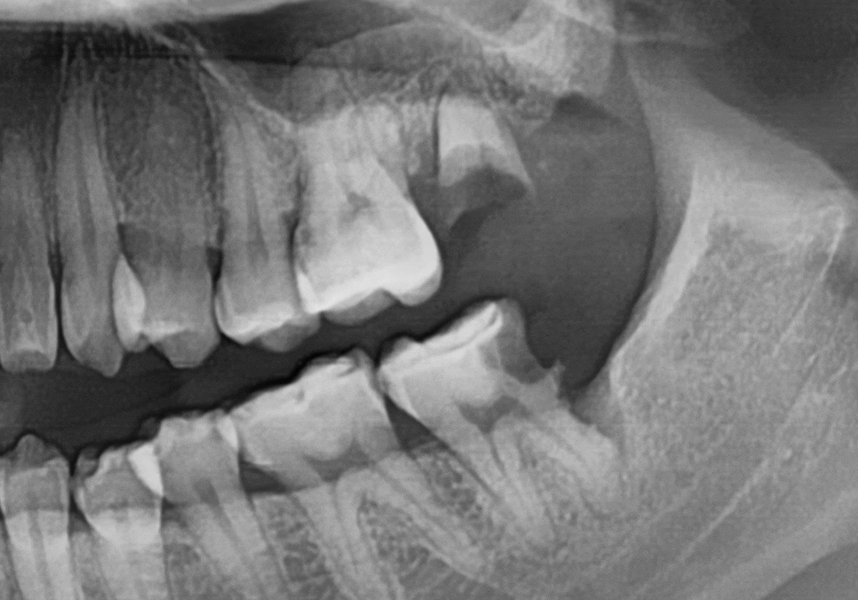 If you lightly brush your backmost molar because the toothbrush can’t reach it, this is what happens. image 5