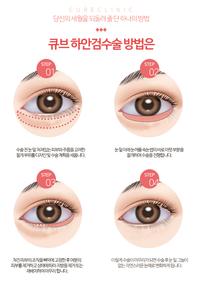 구로구성형외과 큐브하안검! 관련 이미지 3
