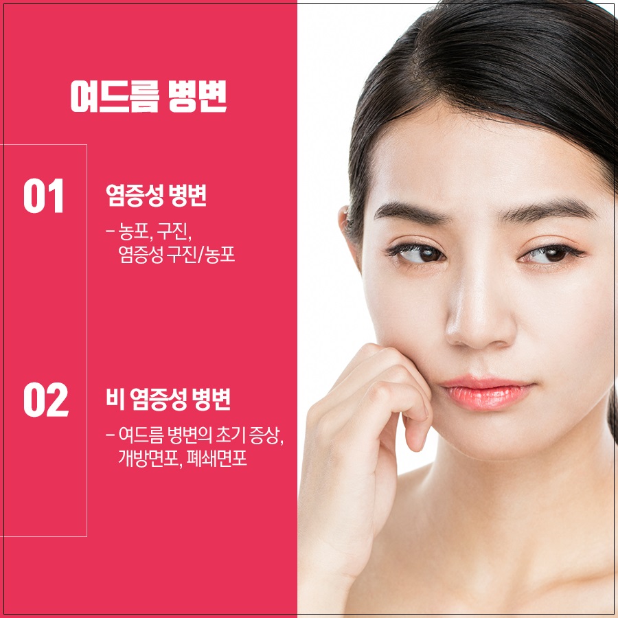 성인여드름 관리 방법 중요한 포인트! 관련 이미지 3