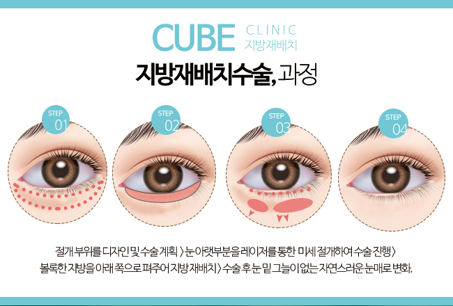 눈밑지방재배치수술시간 빠르고 완벽하게 관련 이미지 3