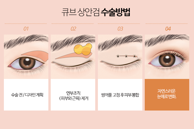 큐브 상안검수술 관련 이미지 3