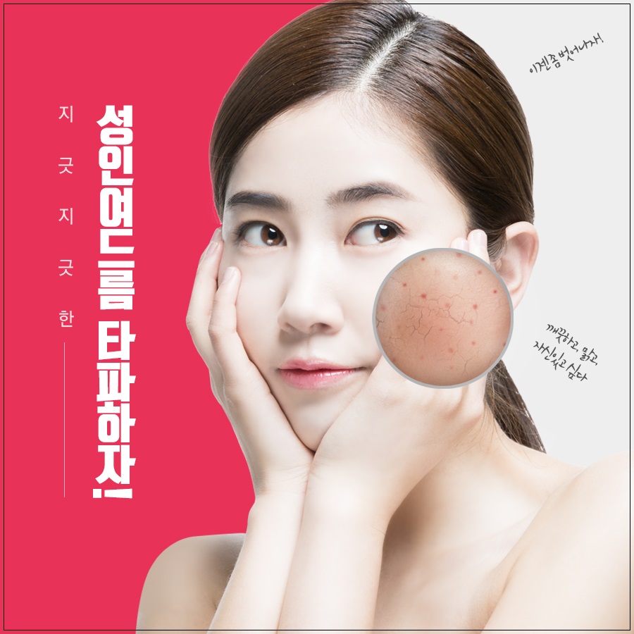 성인여드름 관리 방법 중요한 포인트! 관련 이미지 1