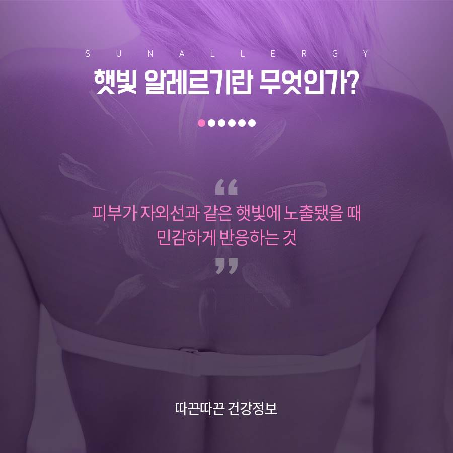 햇빛 알레르기 제대로 예방해요 관련 이미지 2