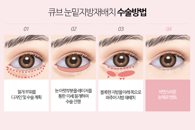 큐브 눈밑지방재배치 관련 이미지 4