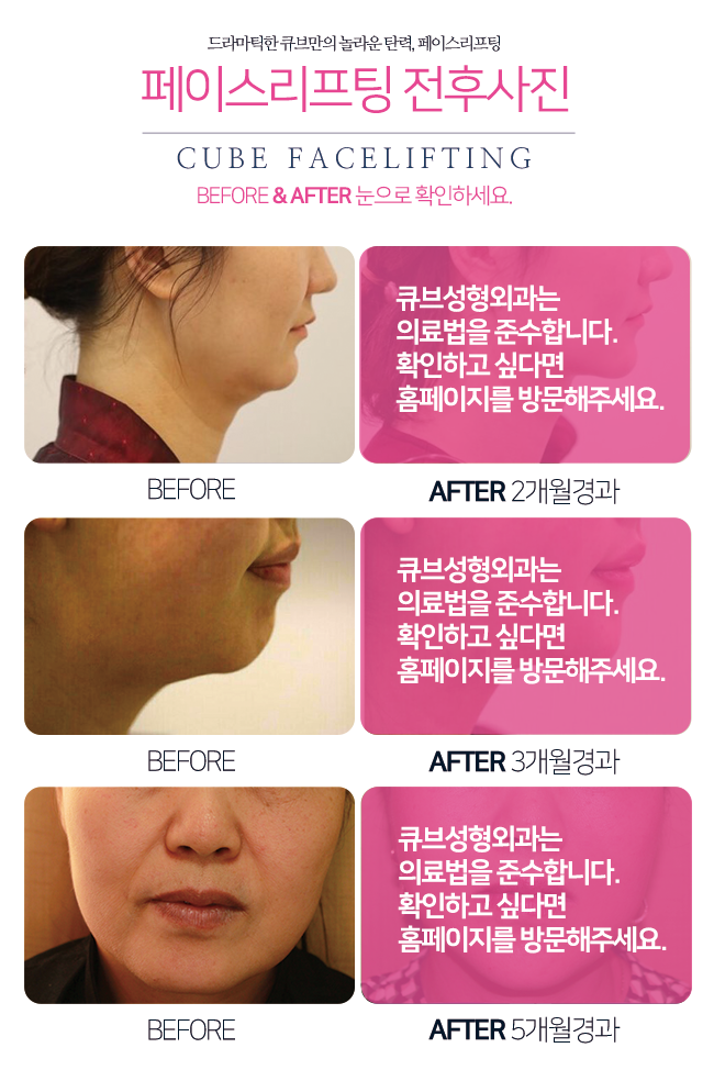 구로구피부과 페이스리프팅은 큐브! 관련 이미지 6