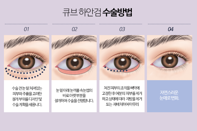큐브 하안검수술 관련 이미지 3