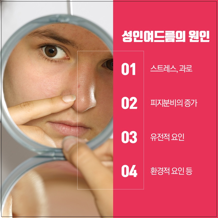 성인여드름 관리 방법 중요한 포인트! 관련 이미지 2