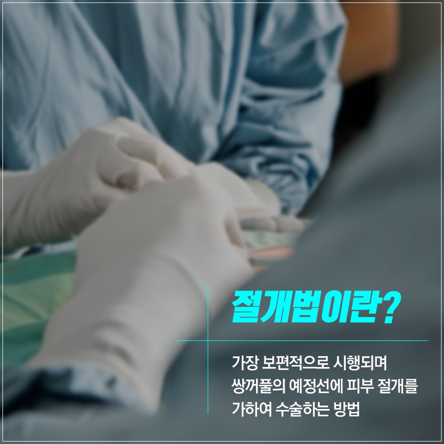 신도림 성형외과 나에게 맞는 눈성형 알려드려요! 관련 이미지 5