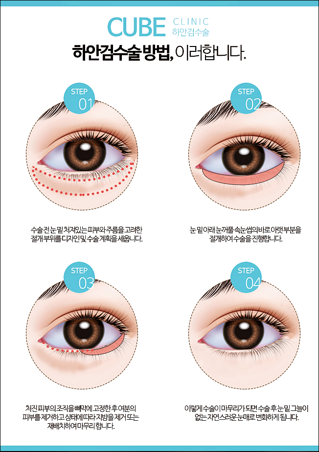 하안검수술 잘하는곳 큐브성형외과 관련 이미지 3