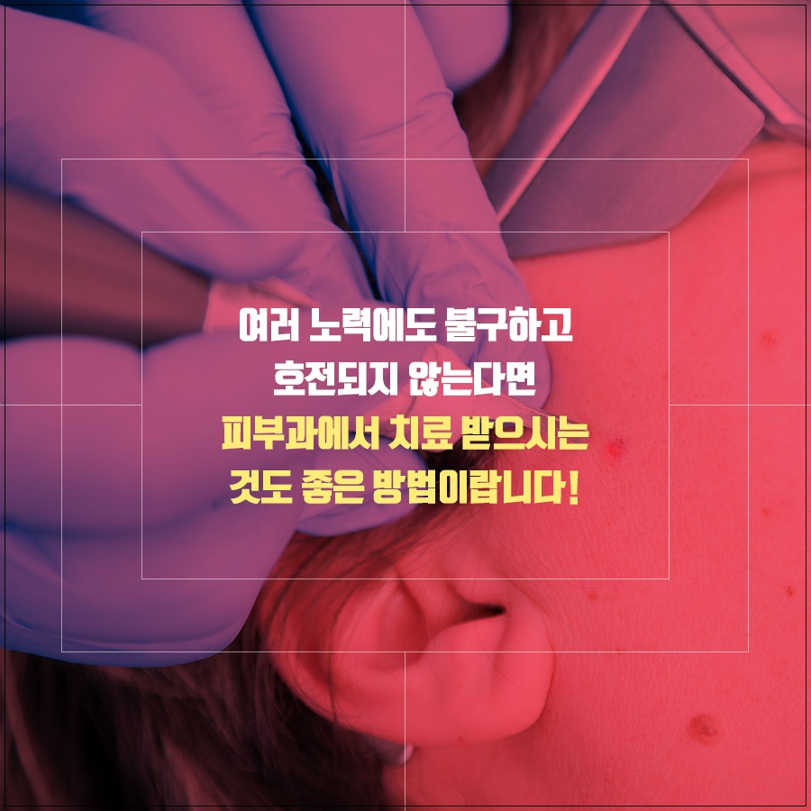 성인여드름 관리 방법 중요한 포인트! 관련 이미지 8