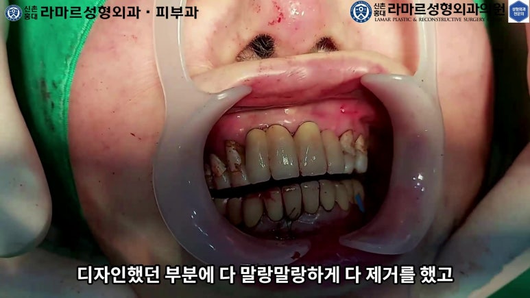 파라핀 필러 입 안 절개로 흉터없이 빼내기! 관련 이미지 85