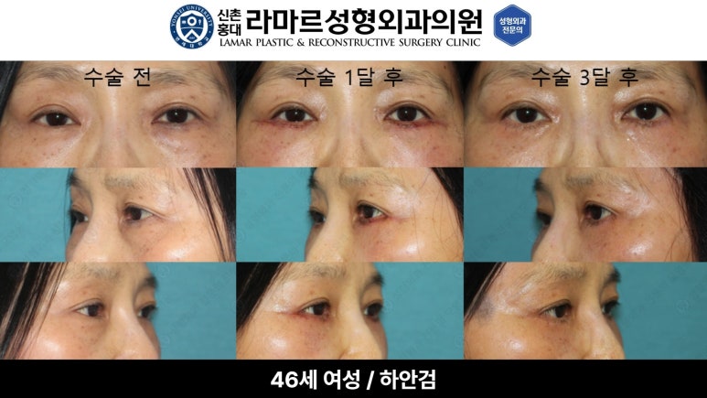 30대~80대 눈 수술 케이스 : 하안검성형술 전후 사진 모음 관련 이미지 27