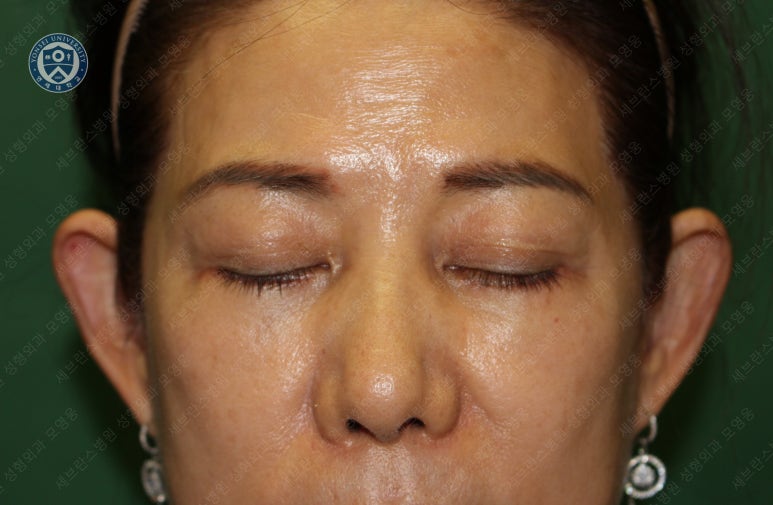 59세 여성, 그레이브스 안병증이 있는 돌출눈 중년 여성 하안검 성형술 (Lower blepharoplasty in Graves 관련 이미지 19