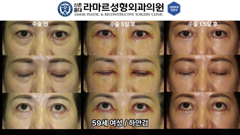 30대~80대 눈 수술 케이스 : 하안검성형술 전후 사진 모음 관련 이미지 48