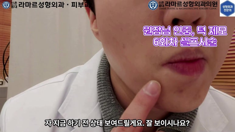 [성형외과 전문의의 셀프시술 제9편] 인중, 아래턱 제모 5,6회차 결과 공개! 관련 이미지 51