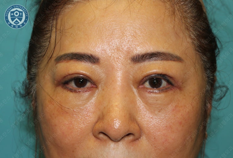 60세 여성, 상안검 및 하안검 성형술 증례 (60/F Upper & lower blepharoplasty) 관련 이미지 15