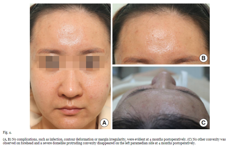 AAPS-Polyacrylamide hydrogel (Aquamid) filler removal after a decade 관련 이미지 6