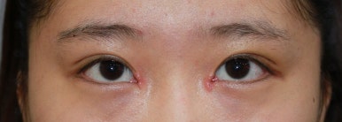17세 여성, 쌍꺼풀+앞트임(DEO+Medial epicanthoplasty) 관련 이미지 16