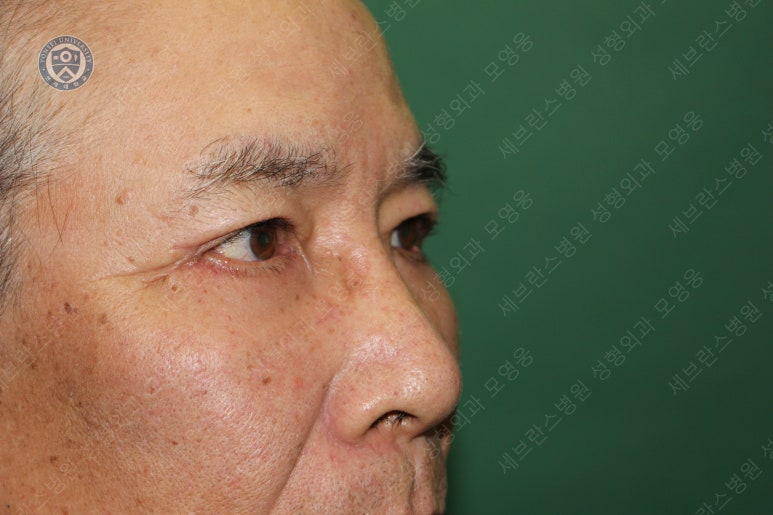 67세 남성, 상&middot;하안검성형술 및 안검하수교정 (67/M, Upper &  lower blepharoplasty with ptosis correction) 관련 이미지 34