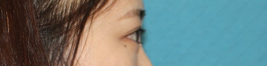 17세 여성, 쌍꺼풀+앞트임(DEO+Medial epicanthoplasty) 관련 이미지 29