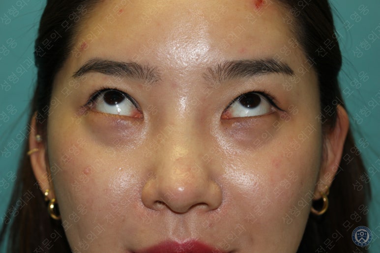 28세 여성 두줄따기, 눈밑지(28/F D.E.O & transconjunctival septal fat redraping) 관련 이미지 5
