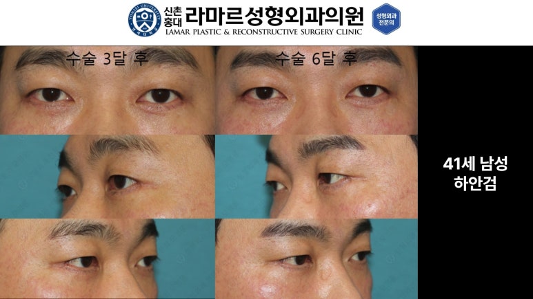 30대~80대 눈 수술 케이스 : 하안검성형술 전후 사진 모음 관련 이미지 19