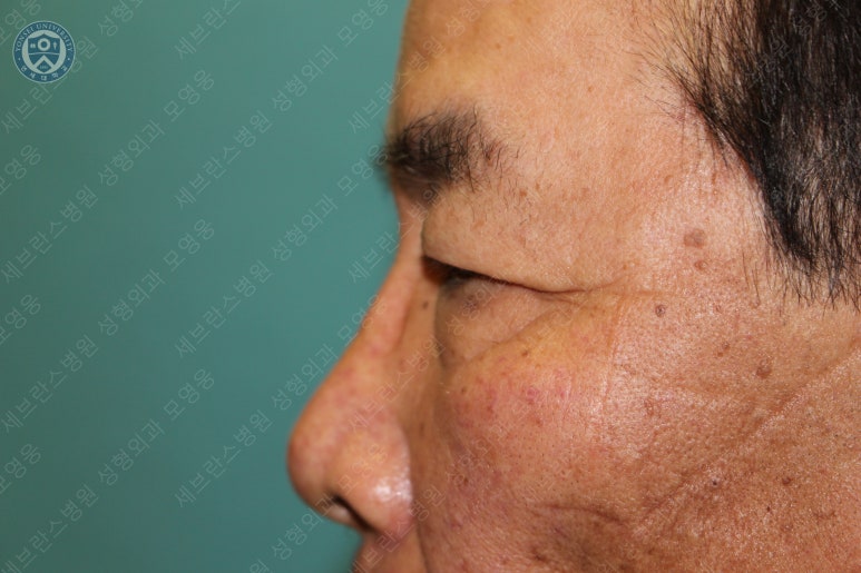 67세 남성, 상&middot;하안검성형술 및 안검하수교정 (67/M, Upper &  lower blepharoplasty with ptosis correction) 관련 이미지 12