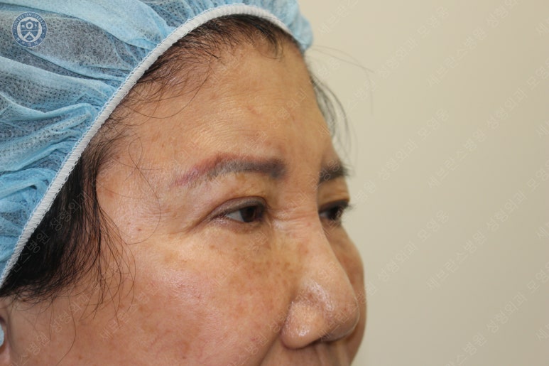 71세 여성, 이마거상술과 이마축소술 (71/F, Forehead lift and reduction) 관련 이미지 16