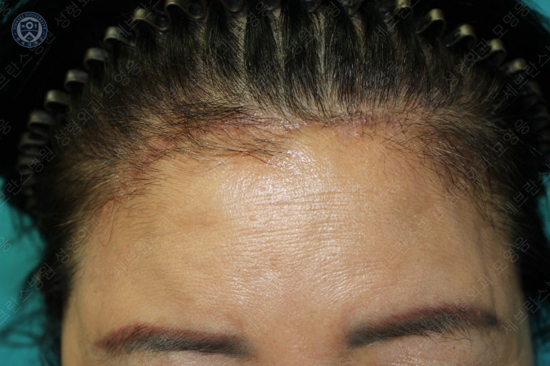 71세 여성, 이마거상술과 이마축소술 (71/F, Forehead lift and reduction) 관련 이미지 48