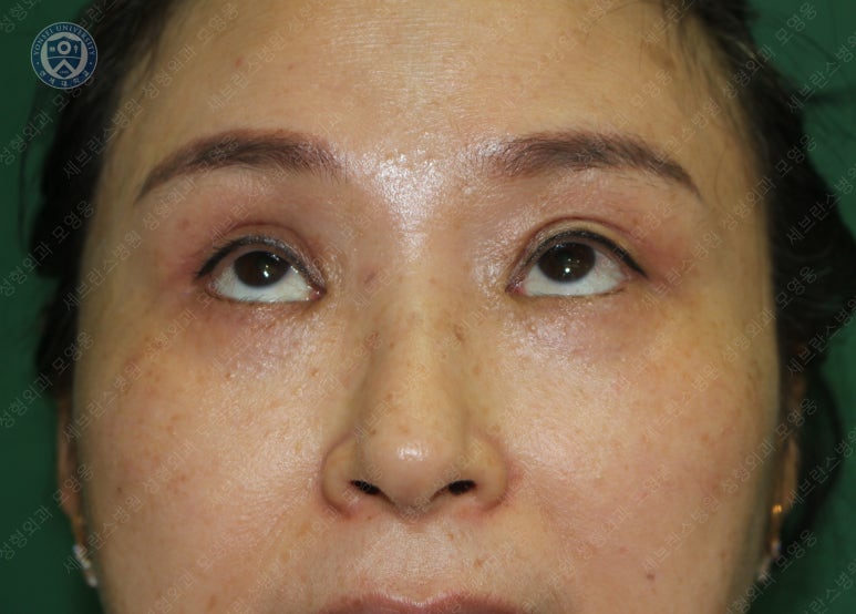 49세 여성, 토안이 있는 중년여성의 상안검성형술 (49/F, Upper blepharoplasty with lagophthalmos correction& LP) 관련 이미지 27