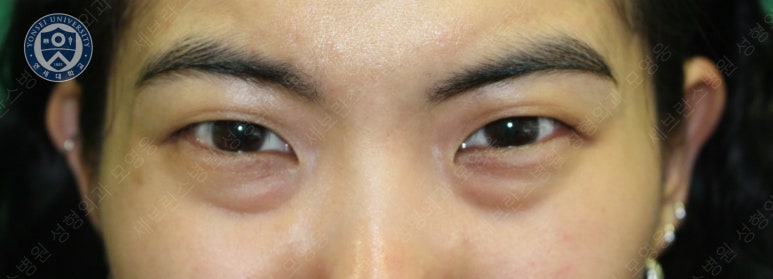 28세 여성, 눈밑지방재배치(눈밑지, 28/F Transconjunctival septal fat redraping-internal fixation technique) 관련 이미지 7