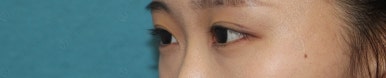 17세 여성, 쌍꺼풀+앞트임(DEO+Medial epicanthoplasty) 관련 이미지 49