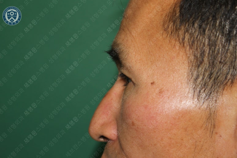 남자눈성형: 무쌍눈매교정 (Blephroptosis correction-levator aponeurosis advancement) 관련 이미지 33