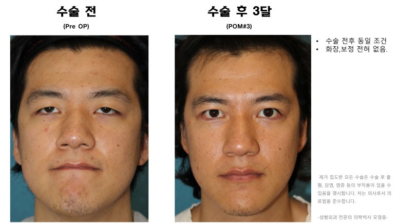 27세 남성 무쌍(속쌍)눈매교정 (27/M Ptosis correction with double lid plasty) 관련 이미지 39