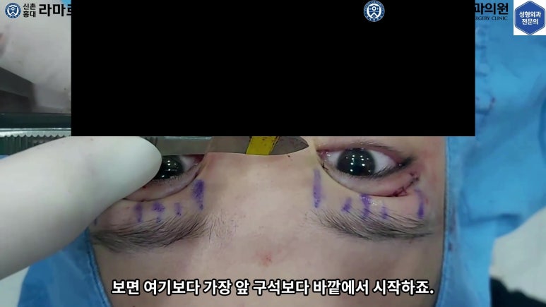 매몰 쌍꺼풀 풀고 절개쌍꺼풀로 바꾸는 쌍꺼풀 재수술!! 관련 이미지 36