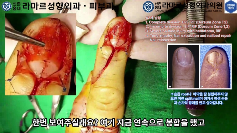 손가락 힘줄 손상 및 열상, 손톱 바닥 열상 처치 (Extensor tendon repair and nailbed injury treatment) 관련 이미지 26