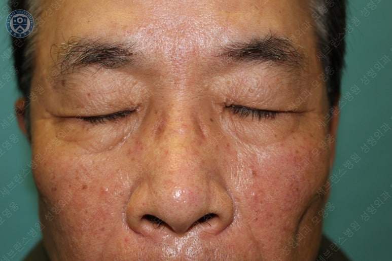 67세 남성, 상&middot;하안검성형술 및 안검하수교정 (67/M, Upper &  lower blepharoplasty with ptosis correction) 관련 이미지 9
