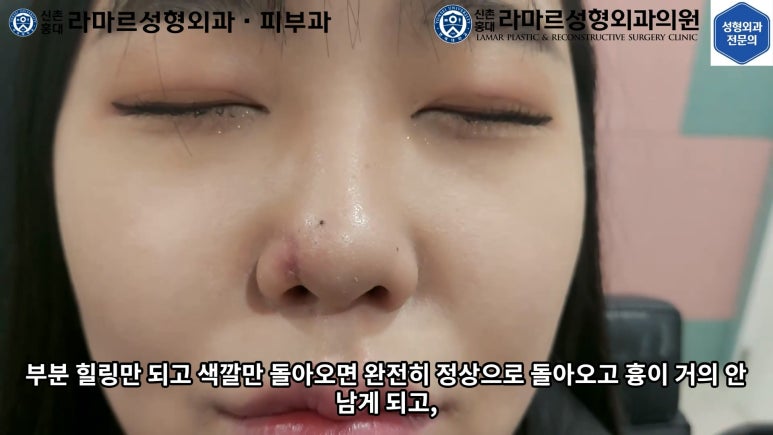지름 1cm 코 점 제거수술 : 나선피판술(Spiral Flap) 수술전~1달 경과. (Feat. 턱끝필러+사각턱 보톡스) 관련 이미지 159