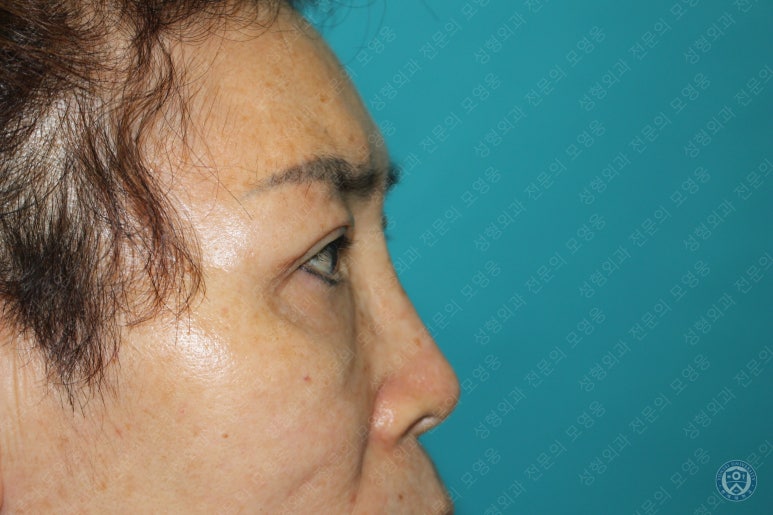 64세 여성 상안검성형술+눈매교정 (64/F Upper blepharoplasty with ptosis correction) 관련 이미지 25