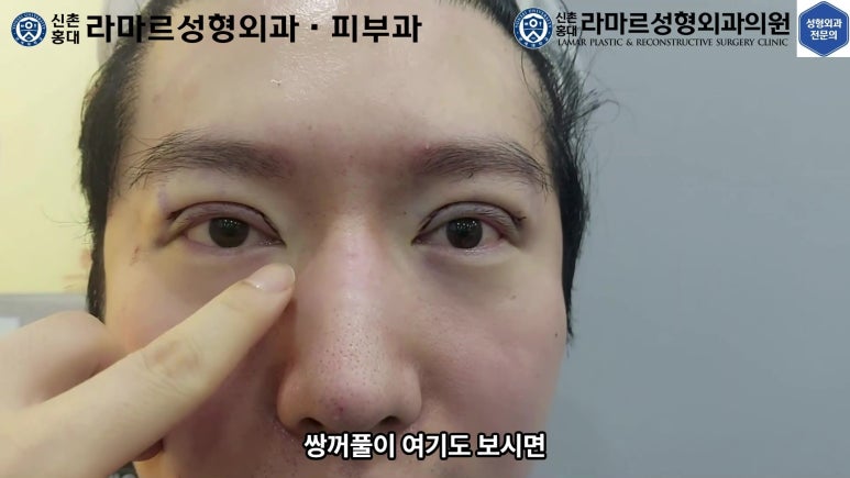 29세 남자, 소시지 쌍꺼풀 두줄따기로 낮추기 (쌍꺼풀 재수술) 관련 이미지 61