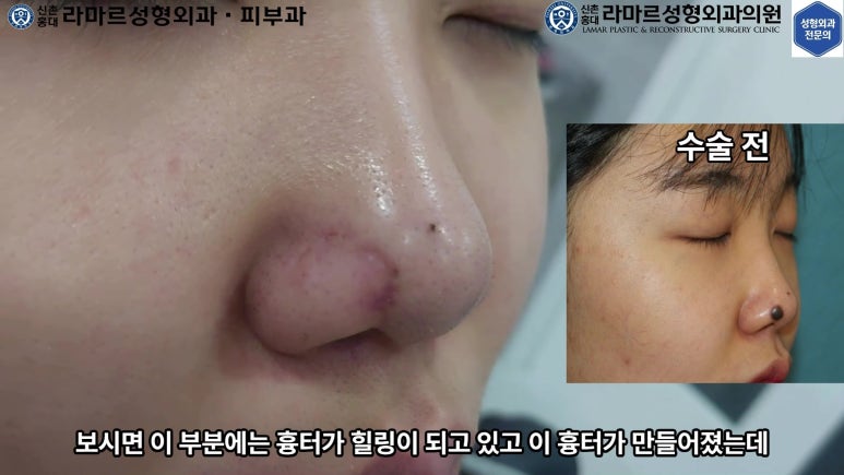 21세 여성 코 지름 1cm 점 제거수술 : 나선피판술(Spiral Flap) 수술전~5달 경과. (+쌍꺼풀수술, 코필러) 관련 이미지 20