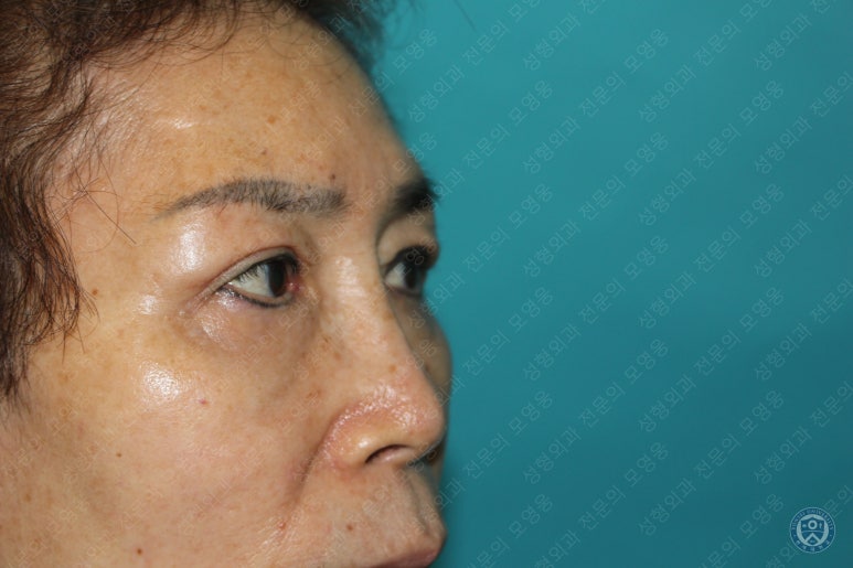 64세 여성 상안검성형술+눈매교정 (64/F Upper blepharoplasty with ptosis correction) 관련 이미지 24